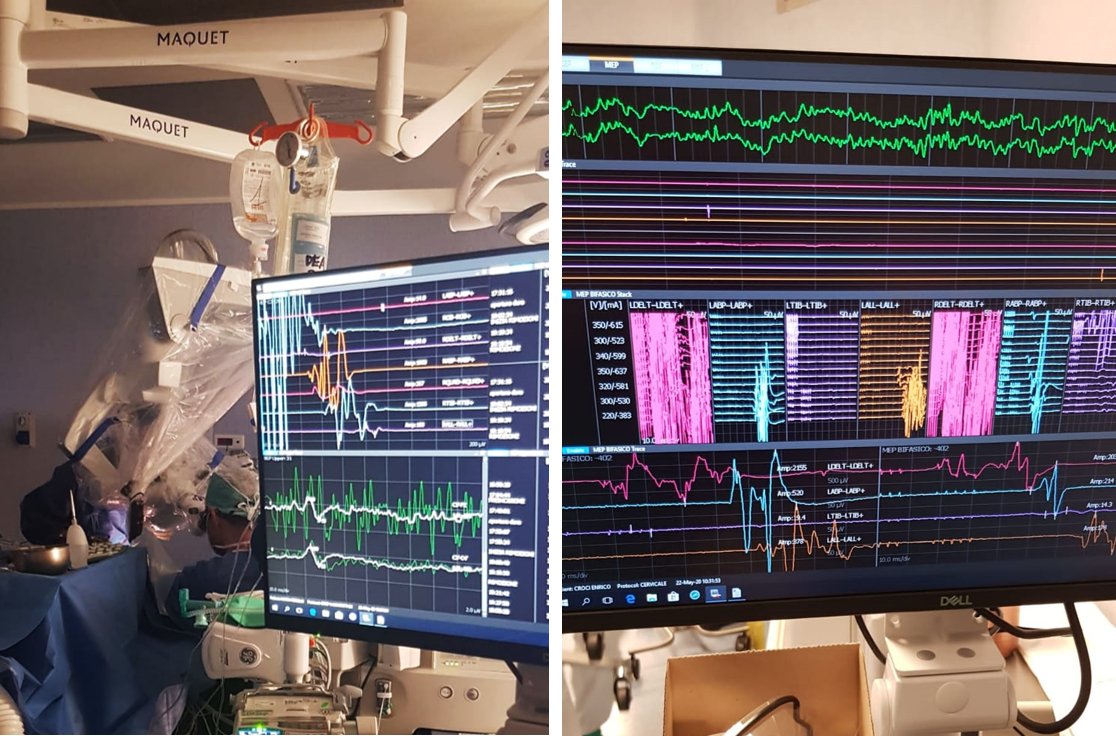 Monitoraggio neurologico